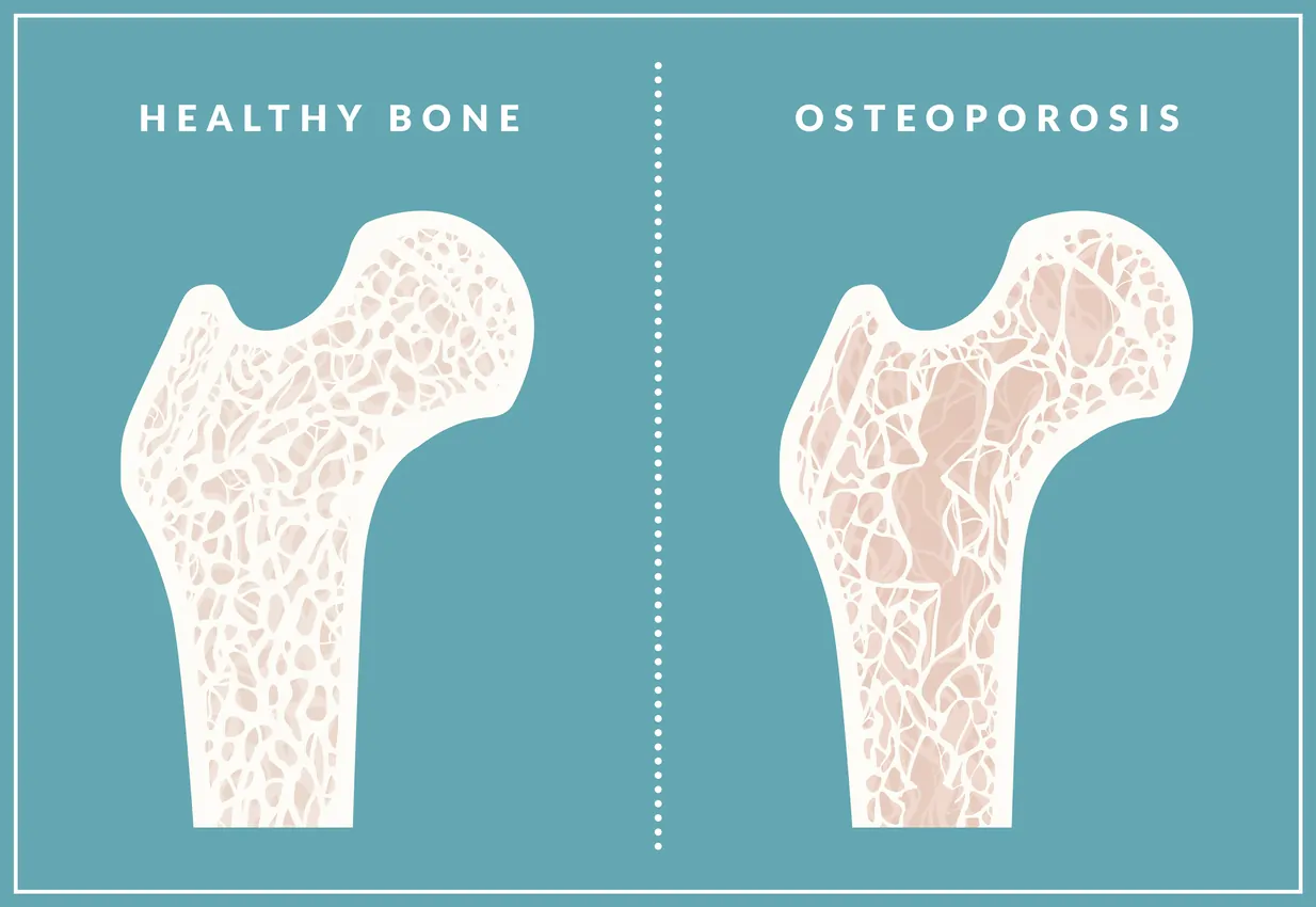 Healthy bone vs osteoporosis bone